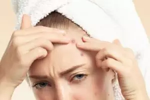 11 Produk skincare untuk jerawat batu merek lokal di bawah Rp 150 ribu, cepat kering dan antikemerahan