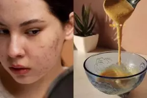 Bebas noda tanpa lemon, ini trik bikin wajah cepat cerah dari bercak pigmentasi pakai 1 jenis umbi