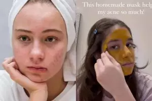 Mulus tanpa air beras, ini trik bikin pori-pori bersih dari kotoran penyebab jerawat pakai 1 minuman