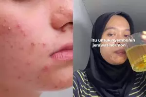 Tak cuma pakai skincare, lihat cara wanita ini atasi wajah berjerawat pakai minuman dari 3 bahan dapur