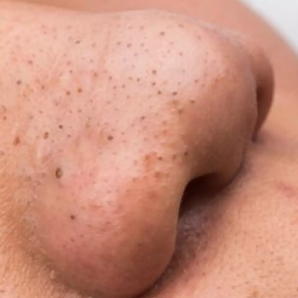 Bersih tanpa porepack, ini trik kurangi komedo berlebih di wajah berminyak pakai 2 bahan pemanis