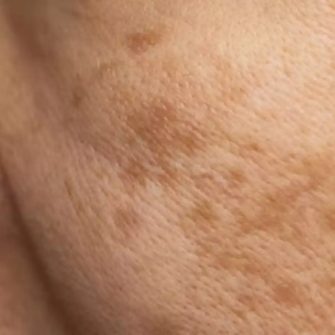 Nggak perlu tambahan kunyit, ini trik hilangkan flek hitam di area pipi pakai 1 jenis umbi-umbian