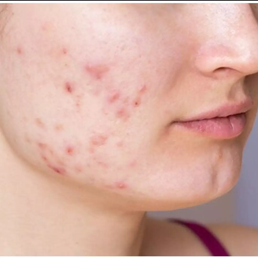 11 Produk skincare untuk menghilangkan bekas jerawat dan mengecilkan pori-pori di bawah Rp 200 ribu