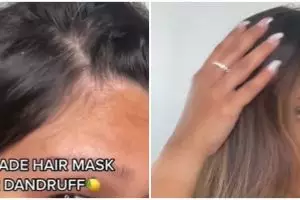 Cuma pakai 2 bahan dapur, trik remaja wanita hilangkan kerak ketombe ini bikin kepala bebas gatal