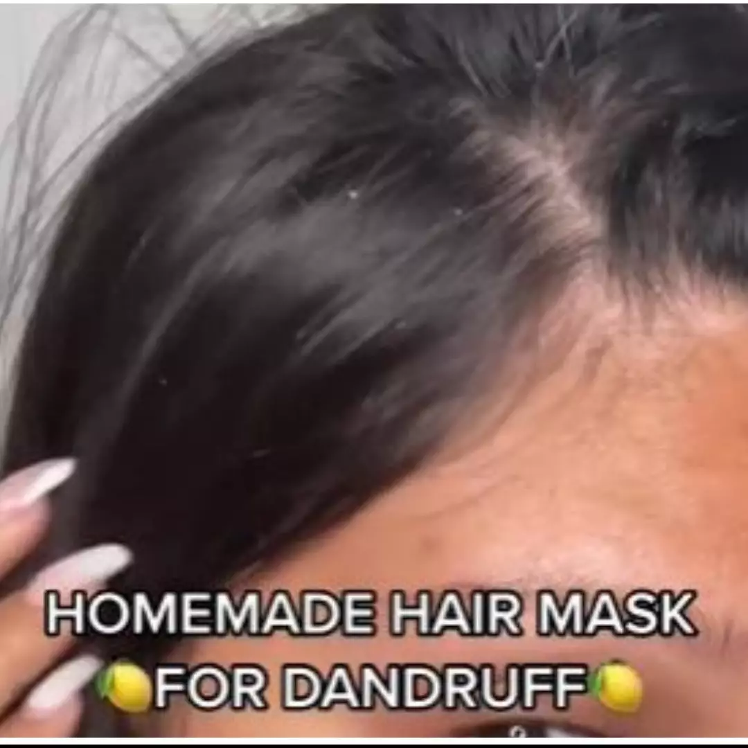 Cuma pakai 2 bahan dapur, trik remaja wanita hilangkan kerak ketombe ini bikin kepala bebas gatal