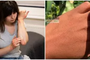 Tanpa gunakan madu dan minyak wijen, ini cara hilangkan bekas luka bakar hanya manfaatkan 1 jenis buah