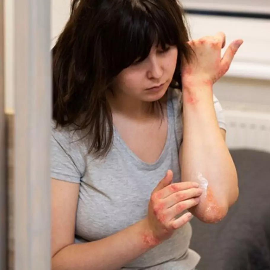 Tanpa gunakan madu dan minyak wijen, ini cara hilangkan bekas luka bakar hanya manfaatkan 1 jenis buah