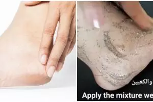 Tanpa gunakan madu, ini cara atasi tumit pecah-pecah agar kenyal bak kulit bayi pakai 1 jenis tepung