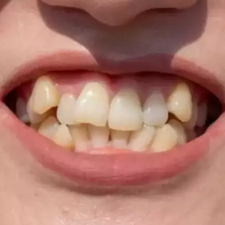 Putih dalam 2 menit, begini cara menghilangkan noda kuning pada gigi dengan 1 jenis bumbu dapur