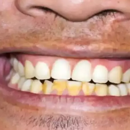 Bukan pakai lemon dan garam, ini trik memutihkan gigi kuning dan atasi bau mulut pakai 1 jenis minyak