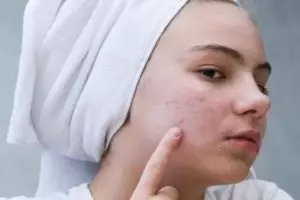 11 Skincare ampuh untuk jerawat jenis day cream harga di bawah Rp 200 ribu, bantu kurangi peradangan