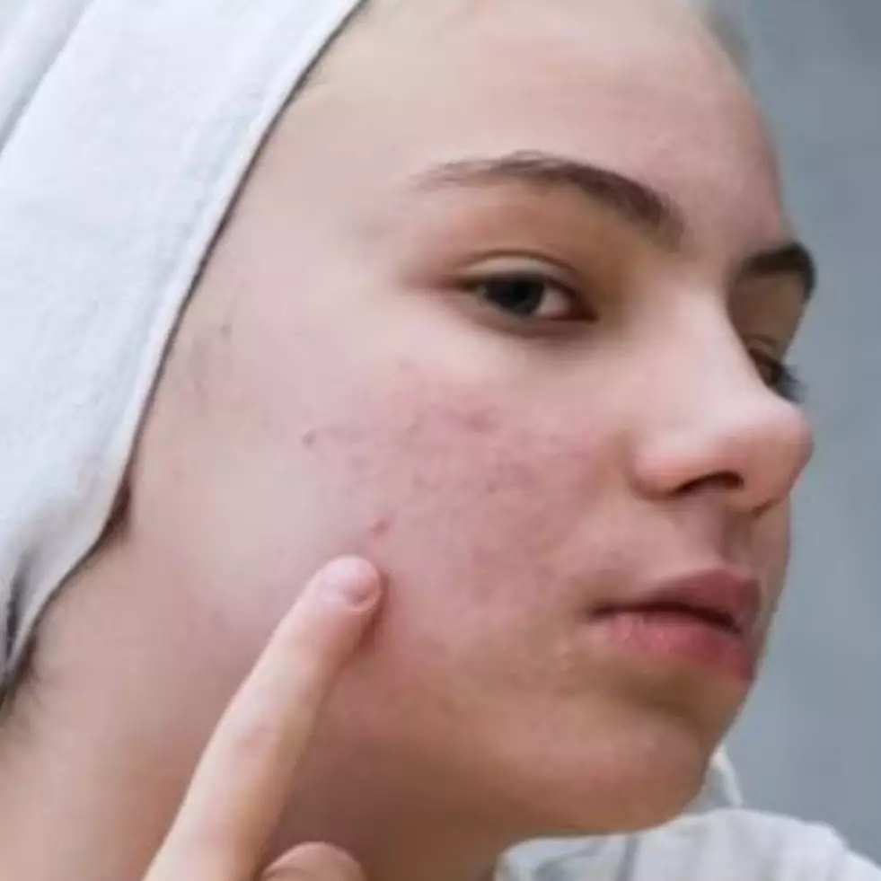 11 Skincare ampuh untuk jerawat jenis day cream harga di bawah Rp 200 ribu, bantu kurangi peradangan