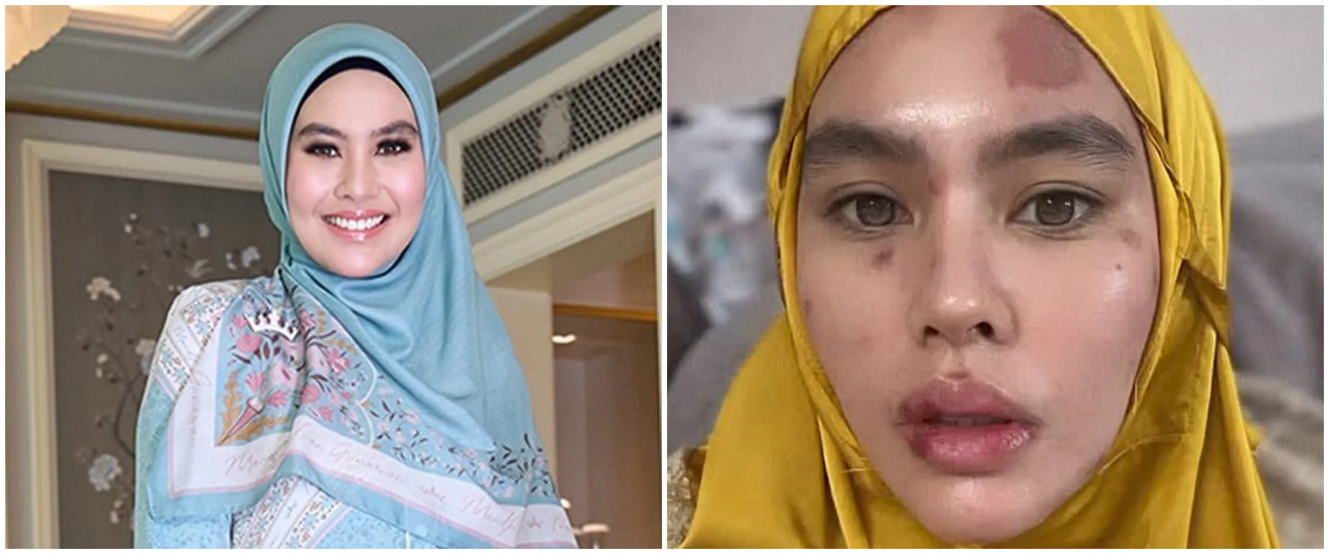 Kulit wajah dan bibir melepuh, begini penjelasan Kartika Putri soal penyebab penyakit yang dialaminya
