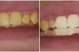 Tanpa bleaching, ini cara hilangkan noda kekuningan pada gigi pakai pasta dari 2 bahan dapur