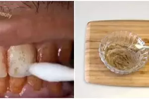 Tak perlu scalling, ini trik pudarkan karang gigi cuma pakai 1 bahan dapur