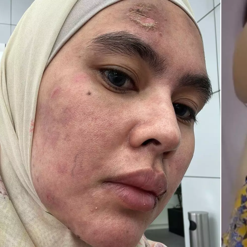 Muka melepuh kini mulus dan kinclong, ini 11 potret transformasi wajah Kartika Putri usai pengobatan