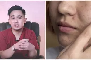 Tanpa gunakan lemon, ini cara menghilangkan jerawat di wajah ala rekomendasi dokter pakai 1 jenis buah