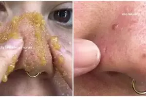 Tanpa pore pack, ini trik beauty enthusiast bersihkan komedo di hidung pakai 2 bahan pemanis