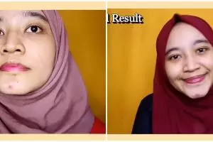 Hasilnya terlihat seminggu, wanita ini tunjukkan cara hilangkan jerawat & bekasnya pakai 1 bahan minum