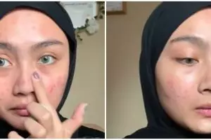 Transformasi makeup cewek kulit berjerawat rias wajah ala peach makeup, hasilnya flawless auto mulus