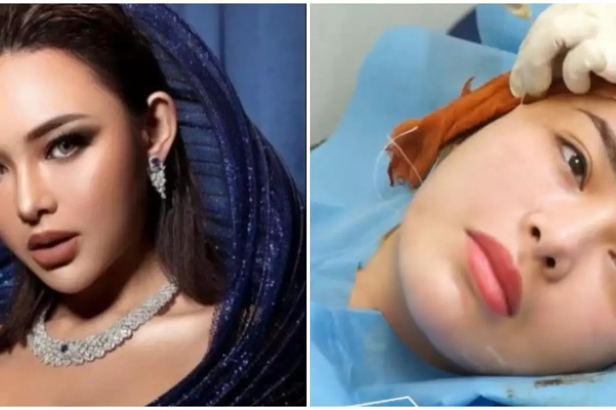 Wajah tirusnya bikin pangling, ini 9 momen Amanda Manopo jalani perawatan kecantikan tanam benang