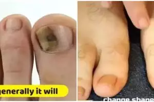 Jadi kinclong kembali, ini 5 cara atasi jamur kuku menguning pakai campuran bahan alami