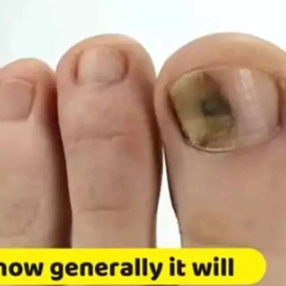 Jadi kinclong kembali, ini 5 cara atasi jamur kuku menguning pakai campuran bahan alami