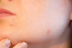 10 Rekomendasi acne patch di bawah Rp 50 ribu, jerawat cepat kempes