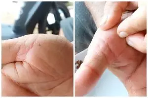 Bukan diambil dengan jarum, ini trik atasi kulit kesusupan cukup andalkan 1 bumbu dapur