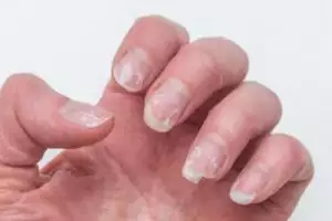 Tanpa andalkan nail serum, ini 5 trik atasi kuku mudah patah dan berwarna kusam pakai bahan alami