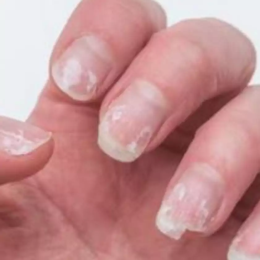 Tanpa andalkan nail serum, ini 5 trik atasi kuku mudah patah dan berwarna kusam pakai bahan alami