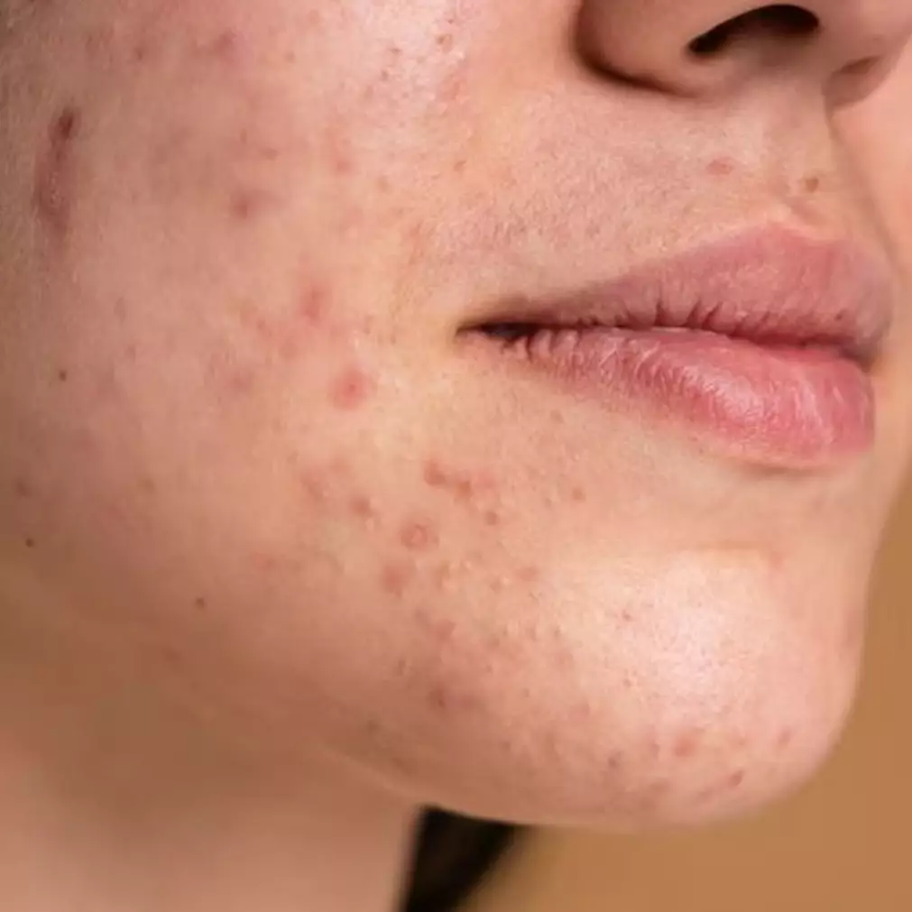 Tak gunakan lidah buaya, ini trik angkat sel kulit mati pada wajah pakai 1 bahan makanan