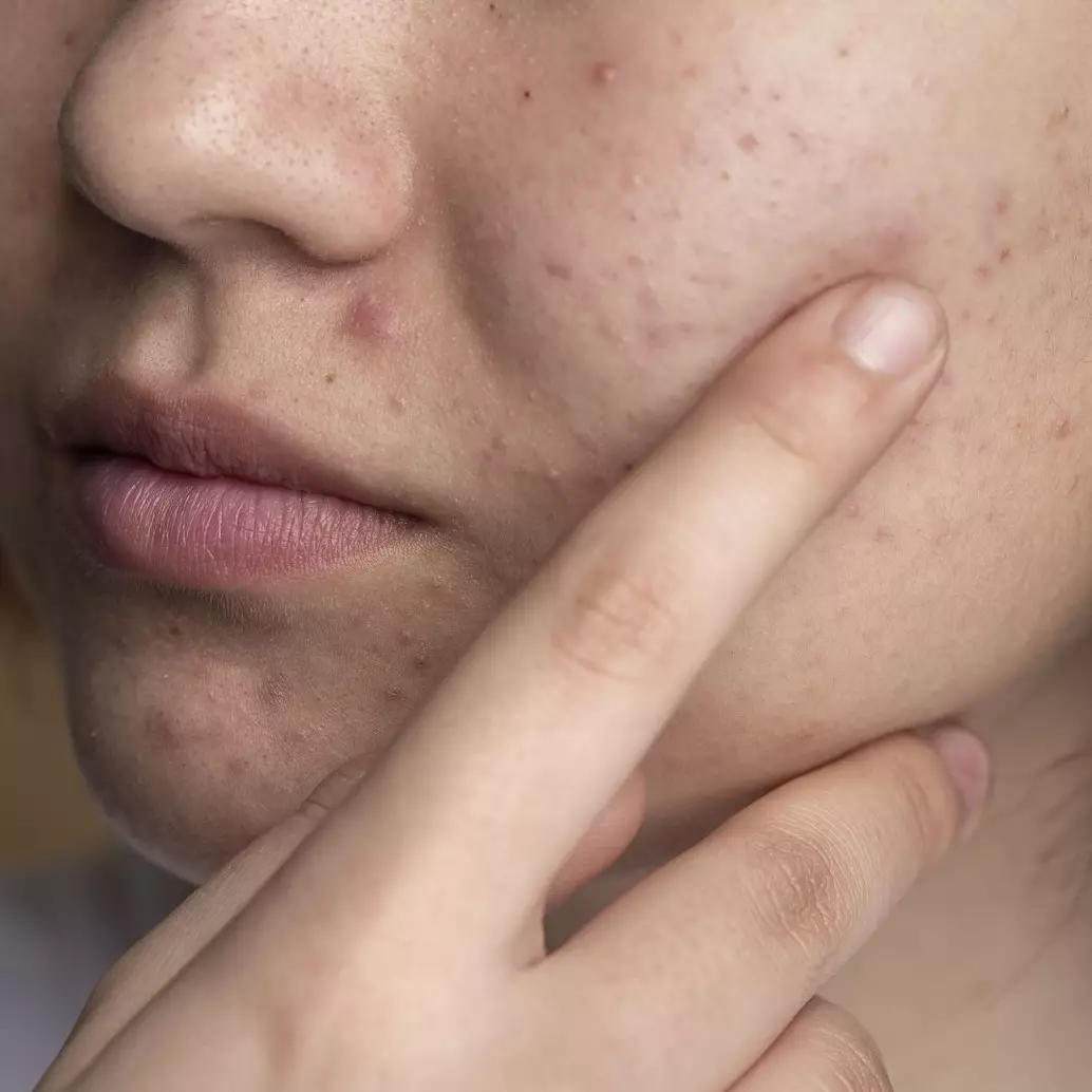 Jangan asal konsumsi, ini 6 bahan makanan yang harus dihindari saat jerawatan ala rekomendasi dokter