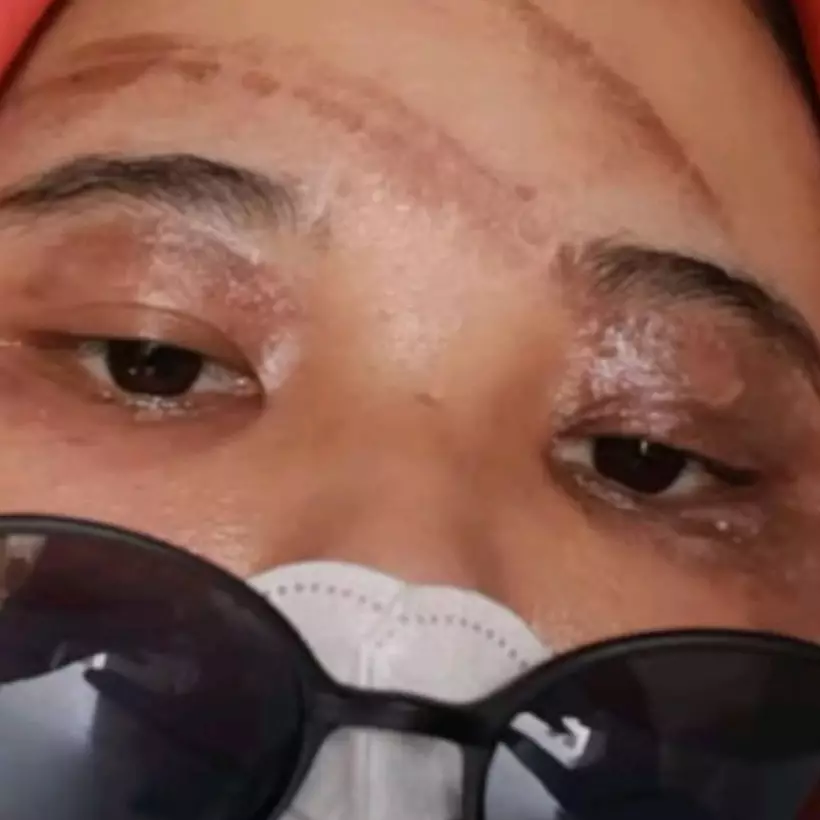 Wanita ini tunjukkan wajahnya usai digigit tomcat sebelum hari pernikahan, potretnya bikin ikut panik