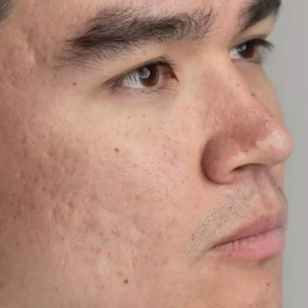 Tak perlu pore pack, cewek ini bagikan cara rapatkan pori-pori besar dengan scrub dari 3 bahan dapur