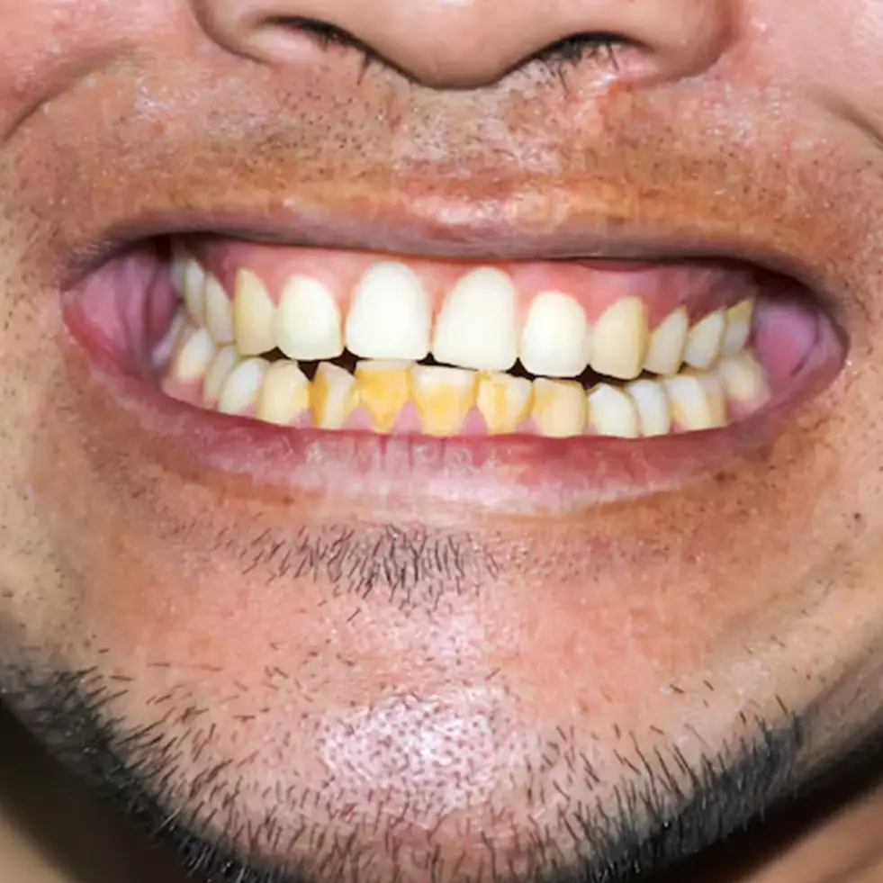 Tanpa baking soda, YouTuber ini bagikan cara hilangkan karang gigi dalam 1 menit pakai 1 bahan rempah