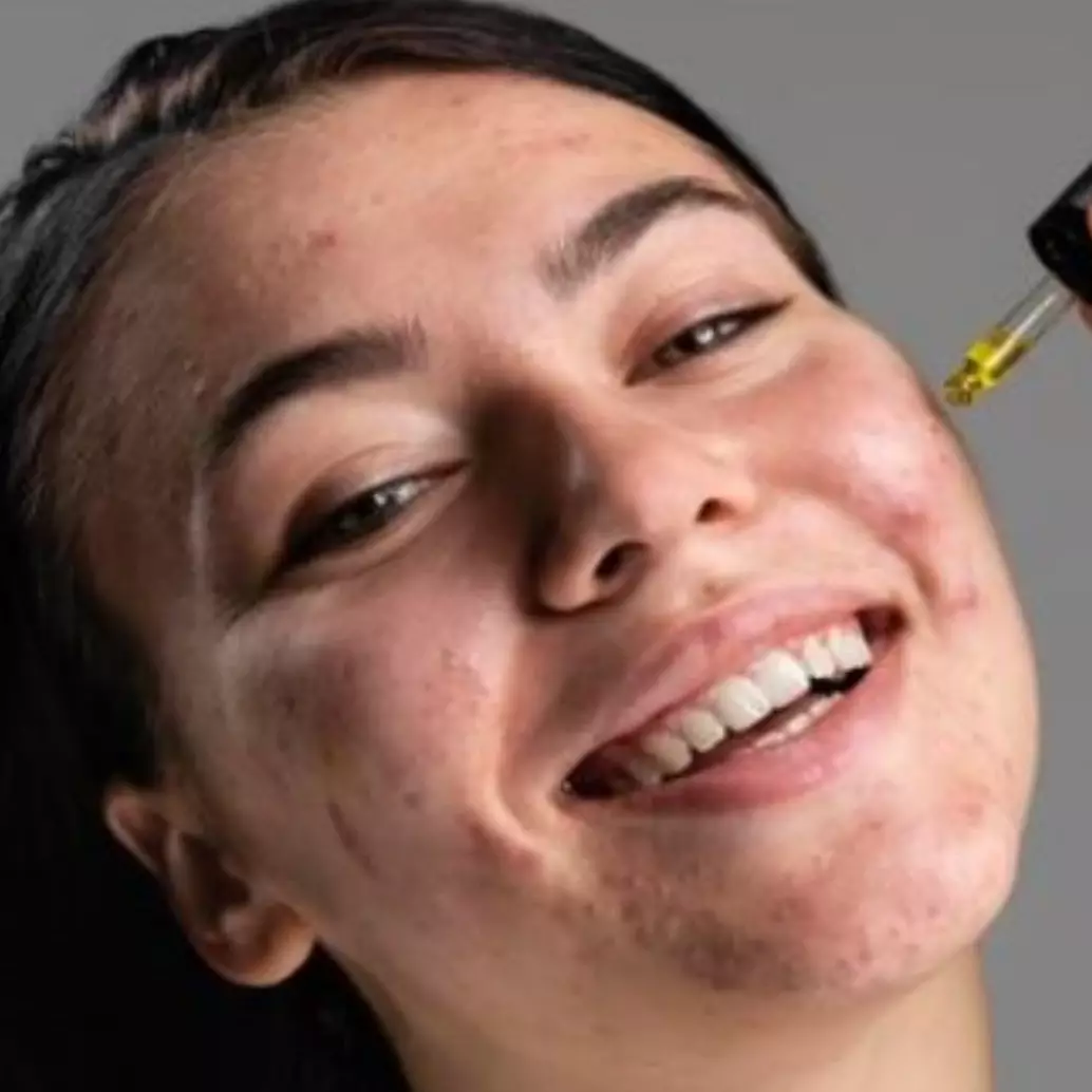 11 Rekomendasi serum jerawat untuk remaja harga di bawah Rp 100 ribu, wajah mulus antikemerahan