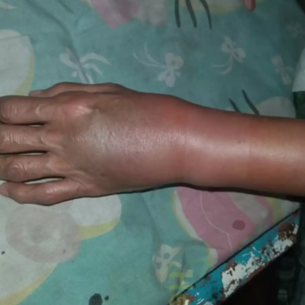 Bukan dikompres es batu, ini cara redakan memar membiru di kulit tangan pakai 1 bahan rempah