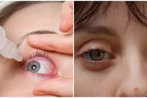 7 Penyebab mata bengkak dan cara menyembuhkannya, redakan nyeri agar penglihatan lebih nyaman