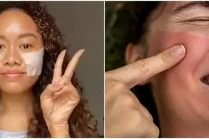 Cara atasi inflamasi pada wajah ini cuma 1 langkah, bikin kulit auto adem