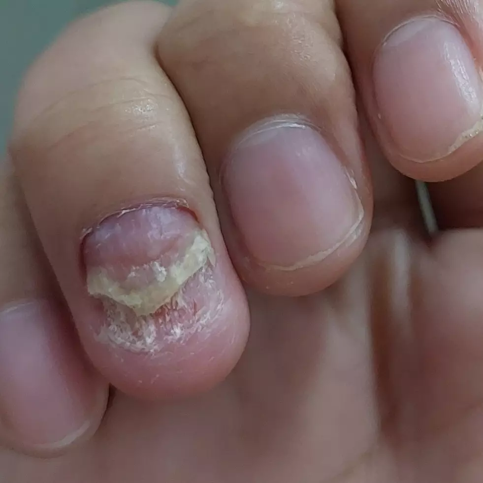 7 Kondisi perubahan kuku ini tanda adanya penyakit serius, jangan disepelekan sebelum terlambat