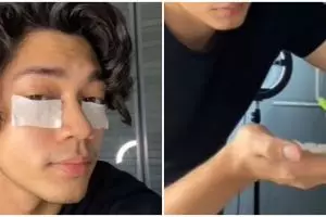 Tak perlu beli eye cream, cara pudarkan mata panda cuma pakai hydrating toner dicampur 1 jenis serum