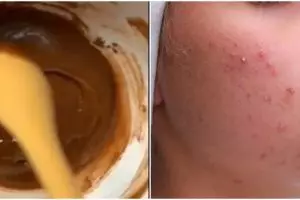 Tak pakai acne patch, YouTuber ini atasi kulit berjerawat gunakan madu dicampur 1 bahan rempah