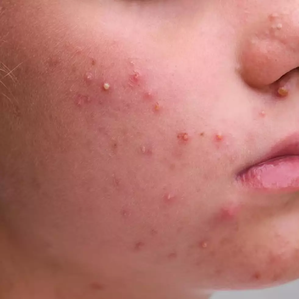 Tak pakai acne patch, YouTuber ini atasi kulit berjerawat gunakan madu dicampur 1 bahan rempah