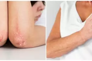 7 Cara ampuh menyembuhkan eksim tanpa konsumsi obat-obatan, cuma modal bahan alami