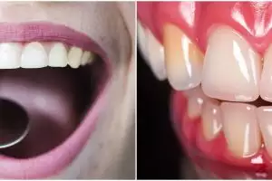Tanpa treatment whitening, pria ini bagikan cara hilangkan karang gigi menghitam dengan 1 bahan dapur