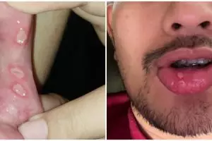 11 Cara efektif sembuhkan sariawan, hindari jeruk agar tak bertambah parah