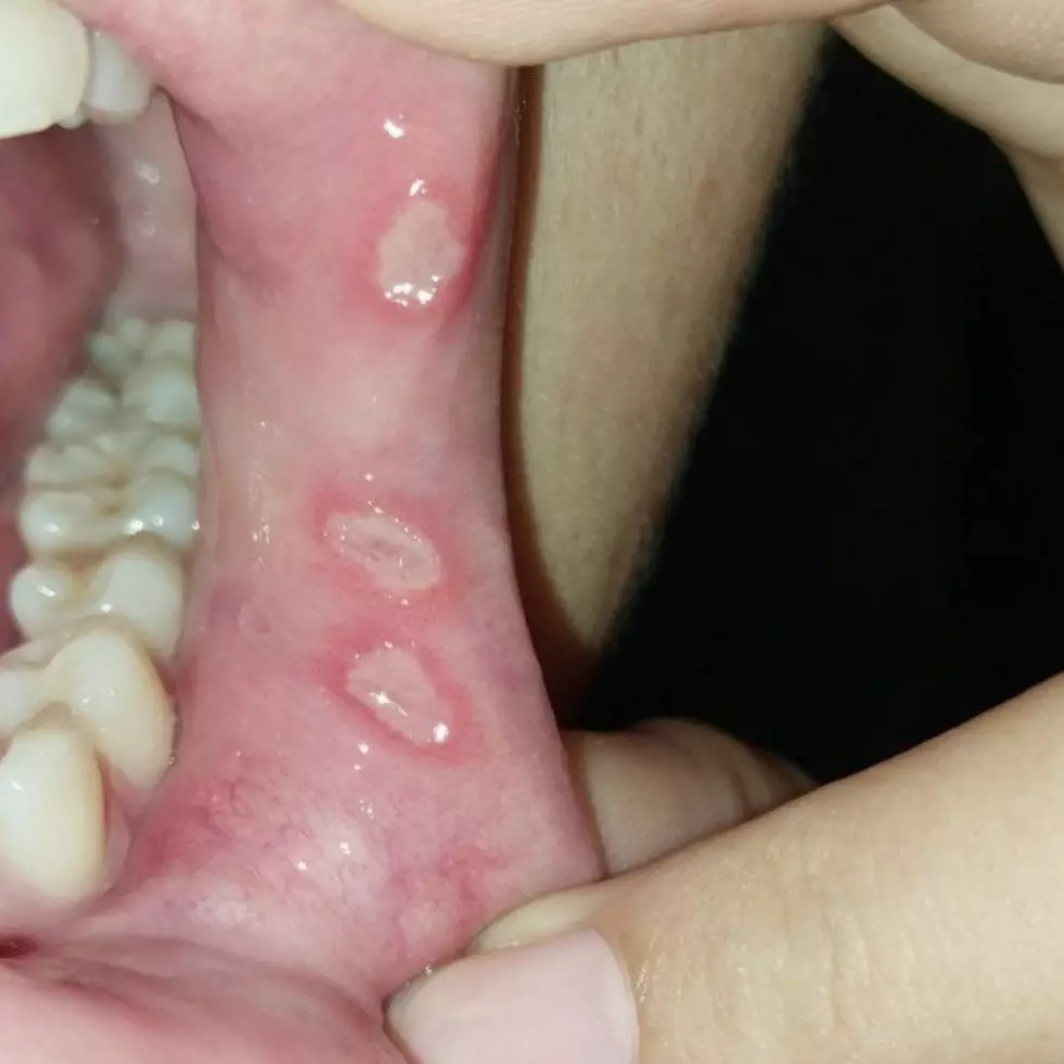 11 Cara efektif sembuhkan sariawan, hindari jeruk agar tak bertambah parah