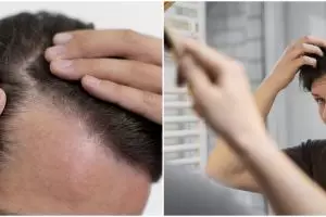 Tanpa hair tonic, pria ini bagikan cara atasi kebotakan agar kembali tumbuh lebat pakai 1 jenis daun