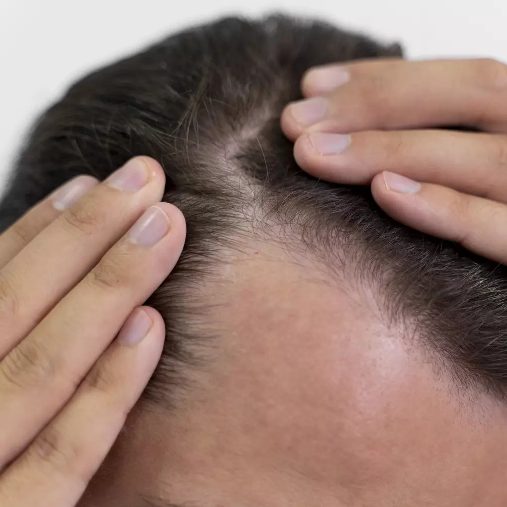 Tanpa hair tonic, pria ini bagikan cara atasi kebotakan agar kembali tumbuh lebat pakai 1 jenis daun